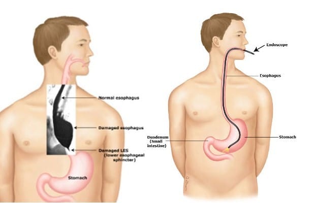 Illustration Achalasia Test