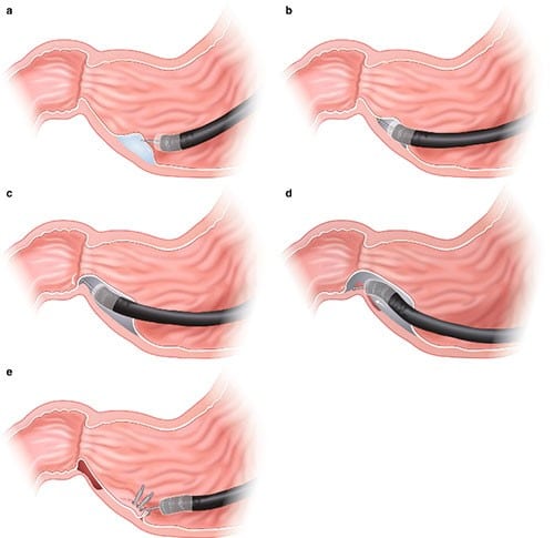 Booklet: How is gastroparesis treated?