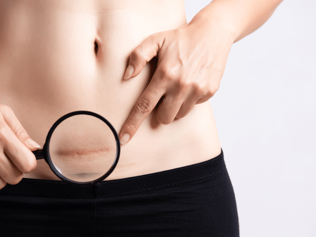 gastric bypass scars