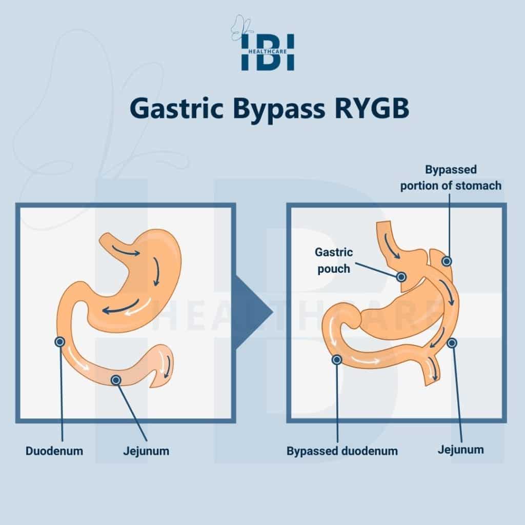LongTerm Diet After Gastric Bypass Surgery