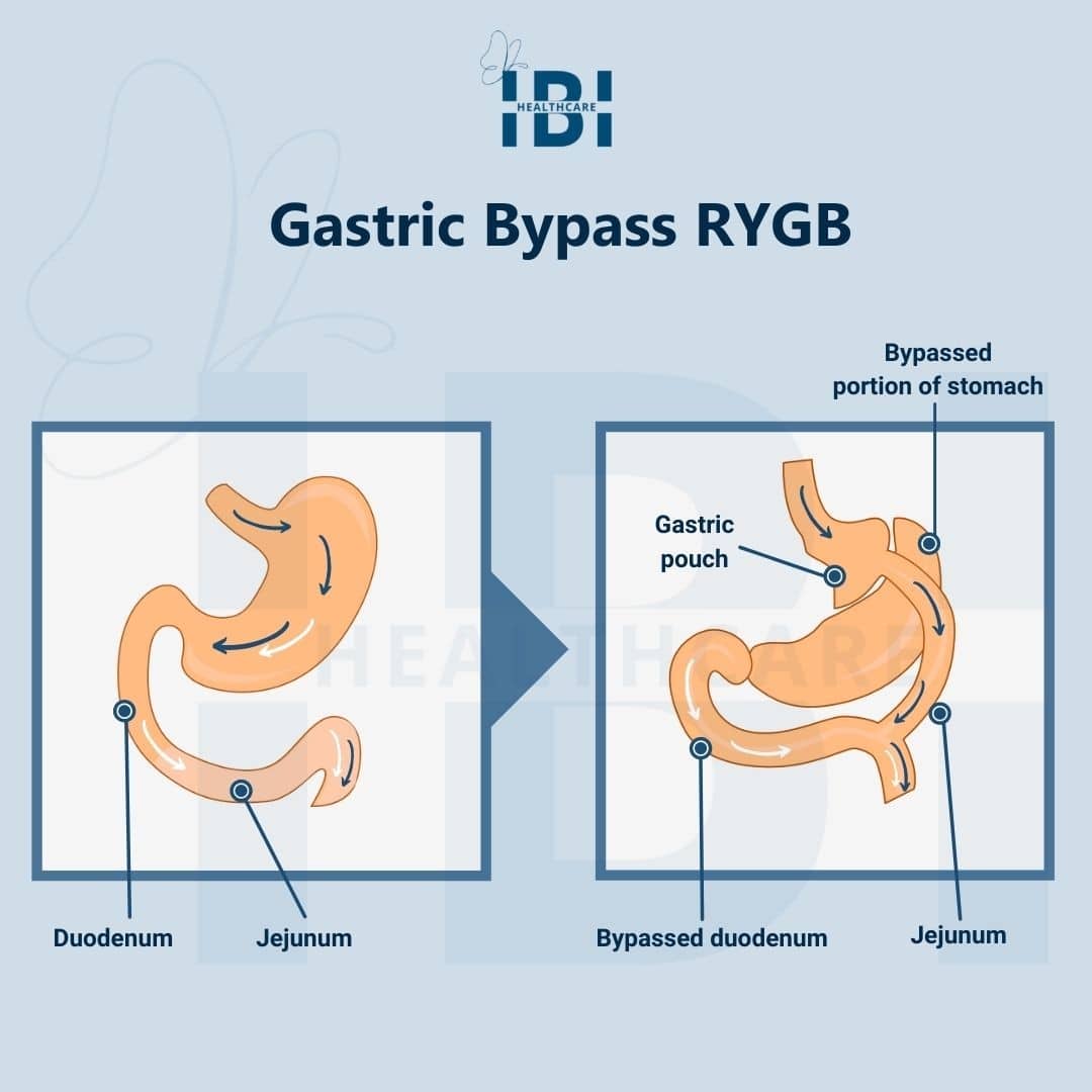 Illustration: Gastric Bypass RYGB