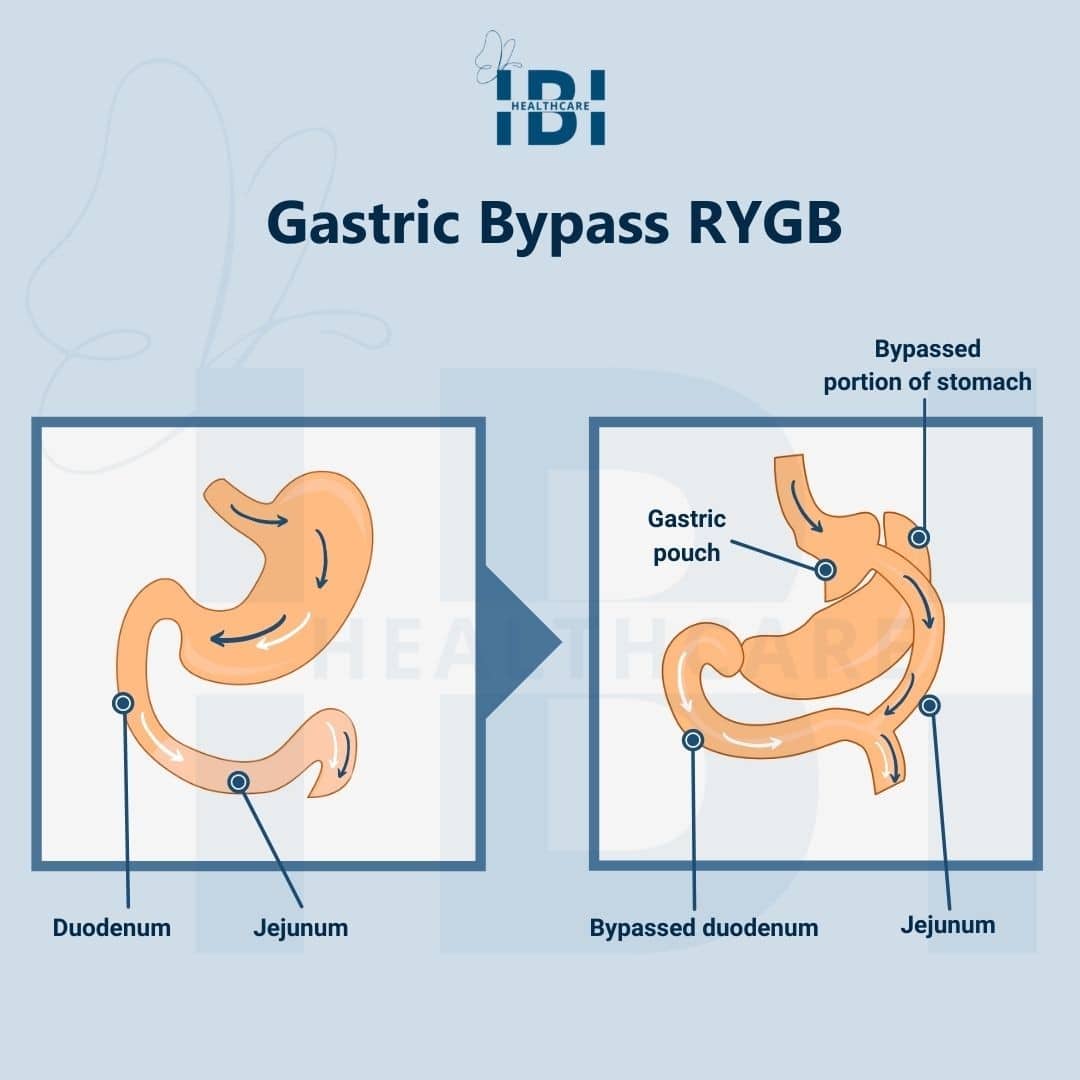 Roux-en-Y Gastric Bypass (RYGB)