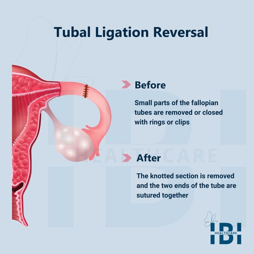 Illustration Of Tubal Ligation Before And After Ligation