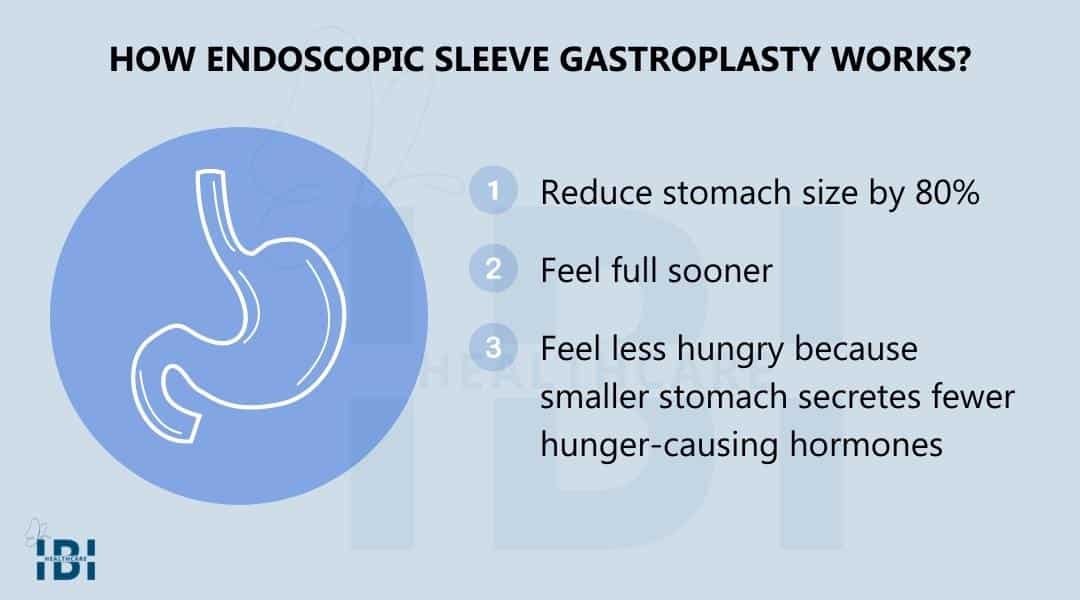 Endoscopic Sleeve Gastroplasty