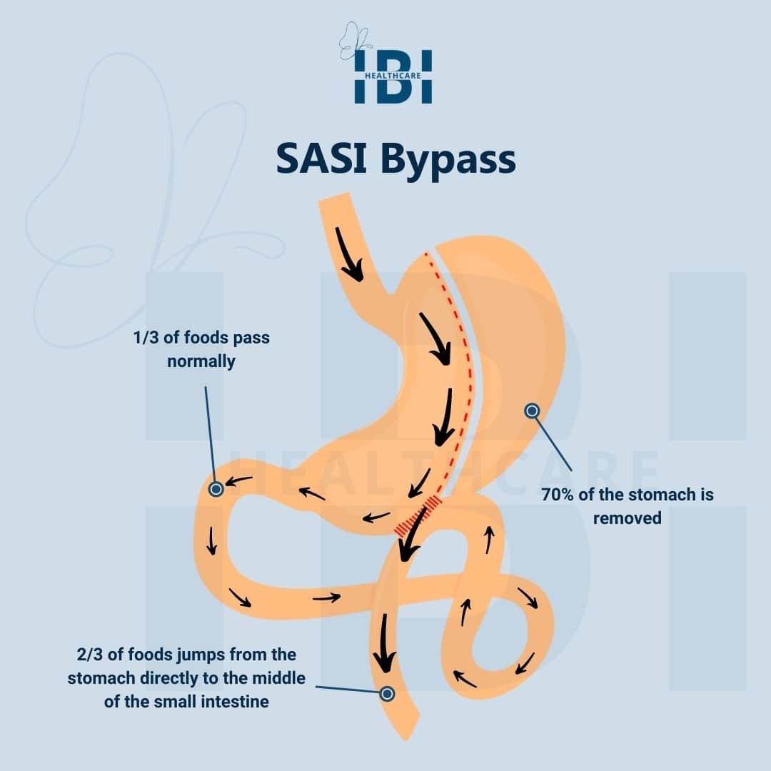 Single Anastomosis Sleeve Ileal Bypass - Weight Loss Procedure