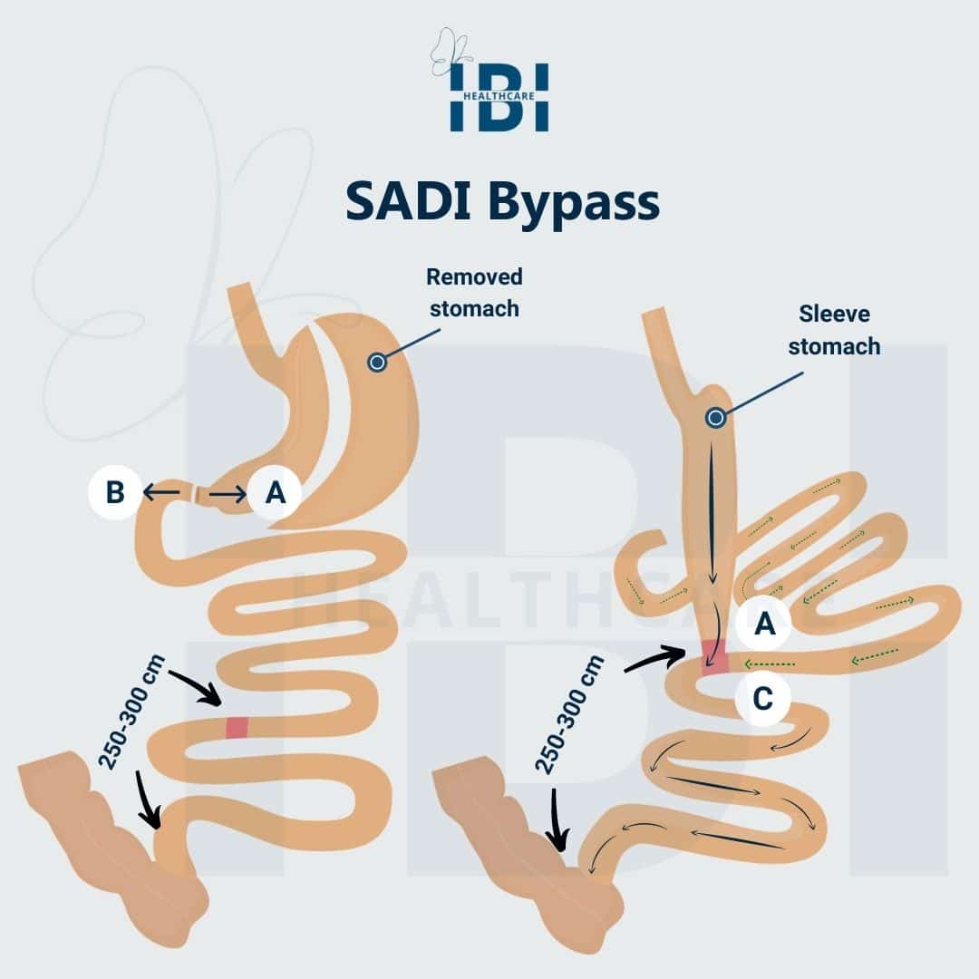 Illustration: how does SADI Bypass work