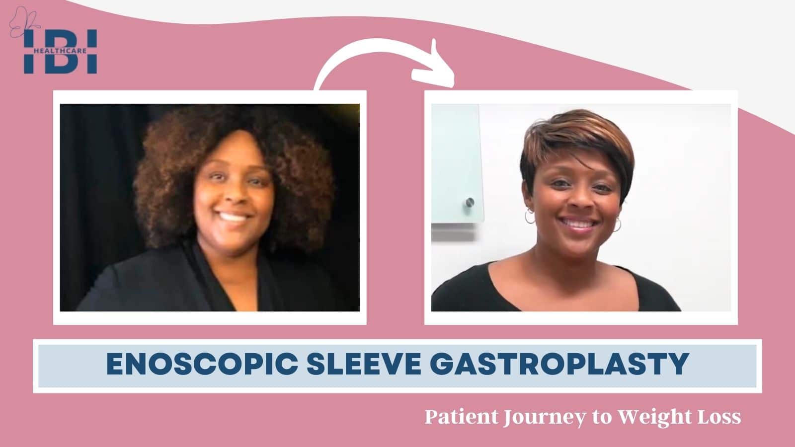 Endoscopic Sleeve Gastroplasty Review Patient Success Story