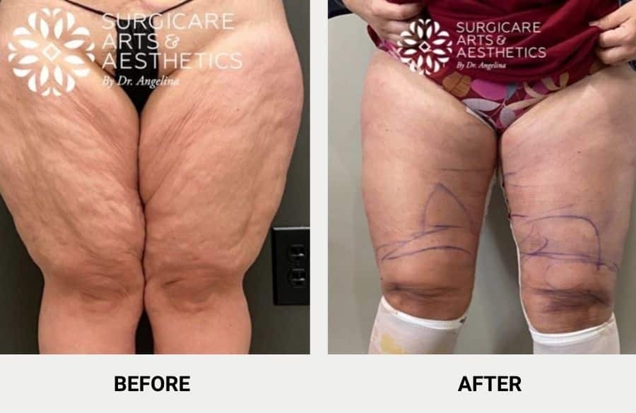 Thigh lift after weight loss