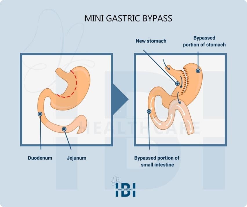 Mini Gastric Bypass Surgery Oagb Ibi Weight Loss Center