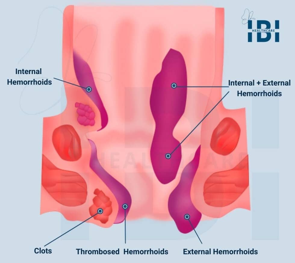 Advanced Hemorrhoid Center