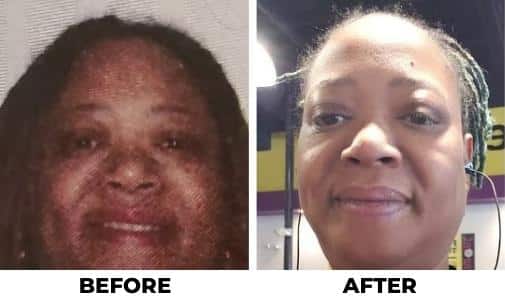 laparoscopic sleeve gastrectomy before and after