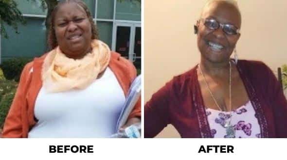 gastric bypass before and after