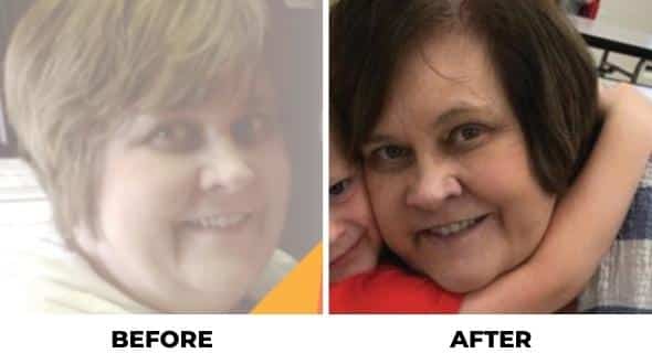 weight loss transformation with orbera
