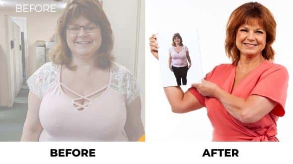 stomach balloon before and after pictures
