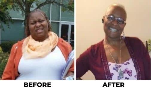 gastric bypass before and after