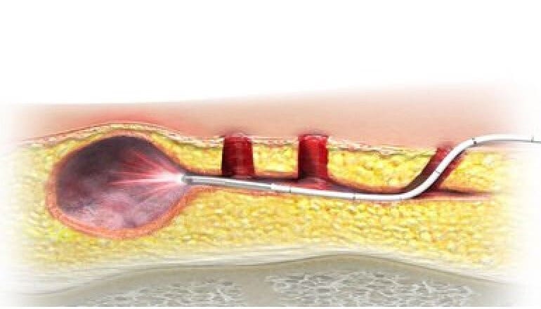 Illustration: Sinus Pilonidalis Laser Ablation  of Pilonidal Cysts (SiLaC)