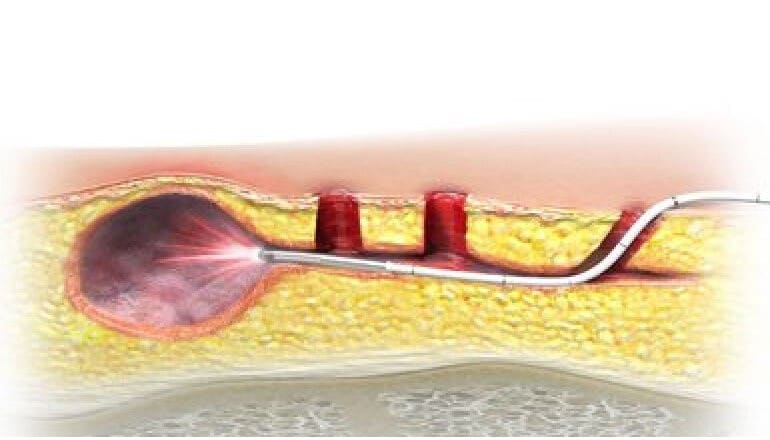 SiLaC® Pilonidal Cysts