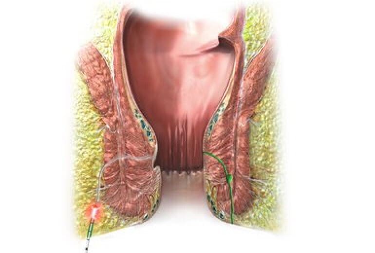 FiLaC® Anal Fistulas