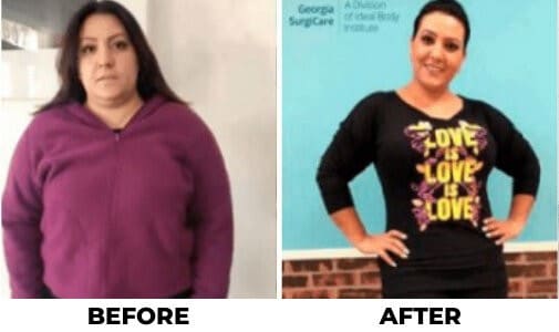 Endoscopic sleeve gastroplasty before and after pictures