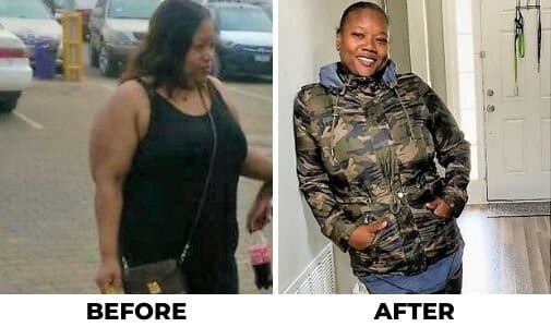 Before and after endoscopic sleeve gastroplasty results