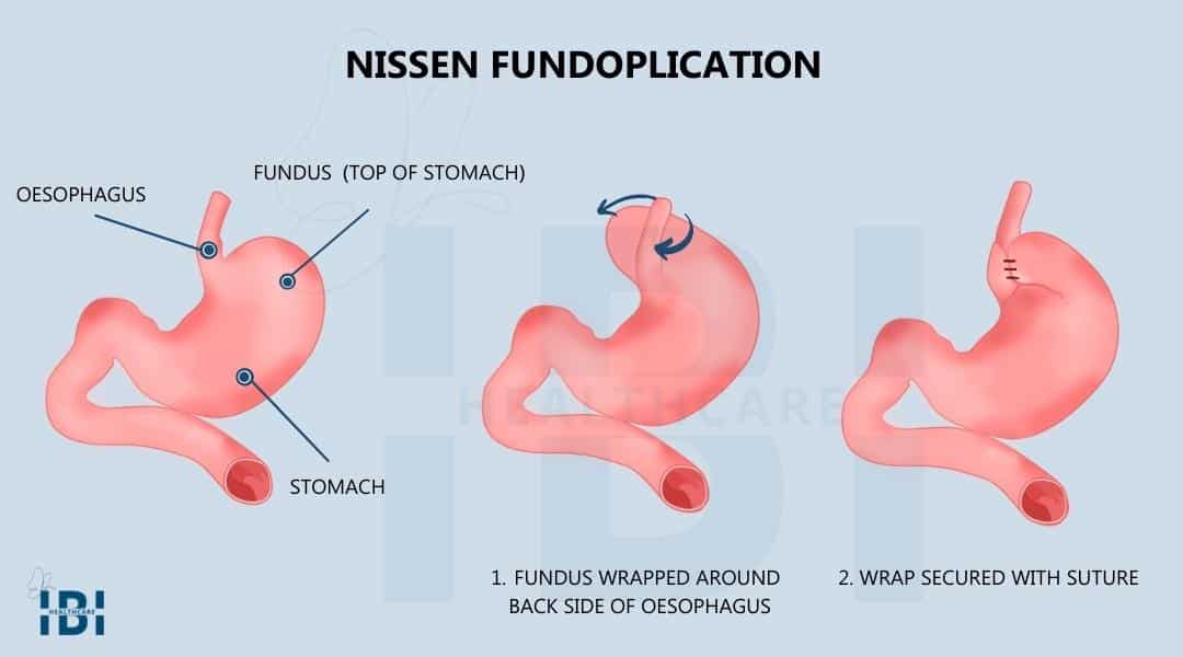 Illustration: How does Nissen fundoplication work?
