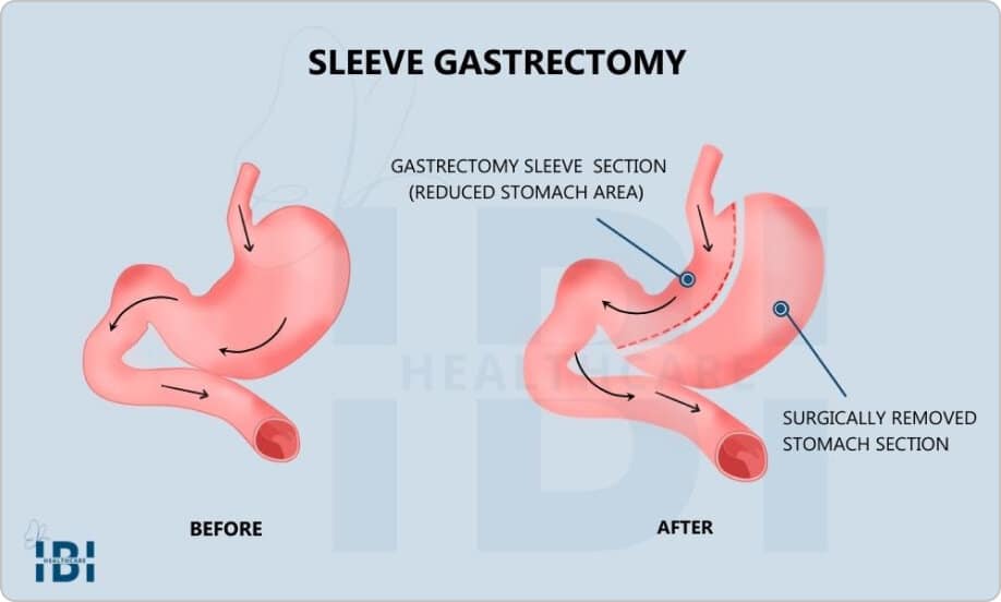 Gastric sleeve surgery