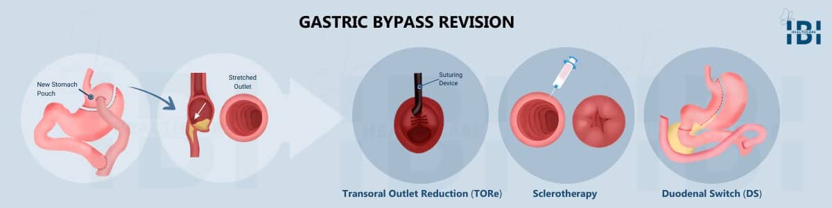 Illustration: Gastric Bypass Revision