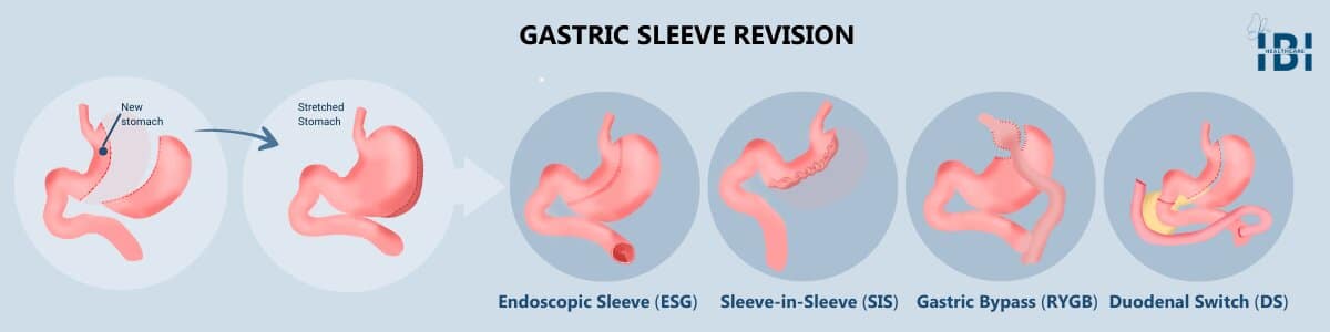 Illustration: Gastric Sleeve Revision