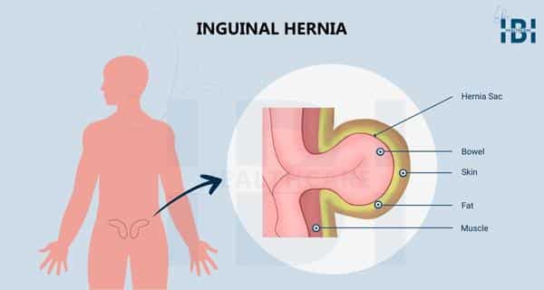 inguinal hernia