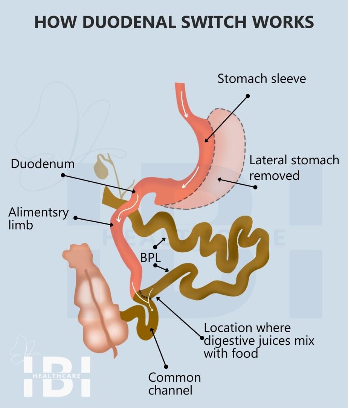 Illustration: How duodenal switch surgery