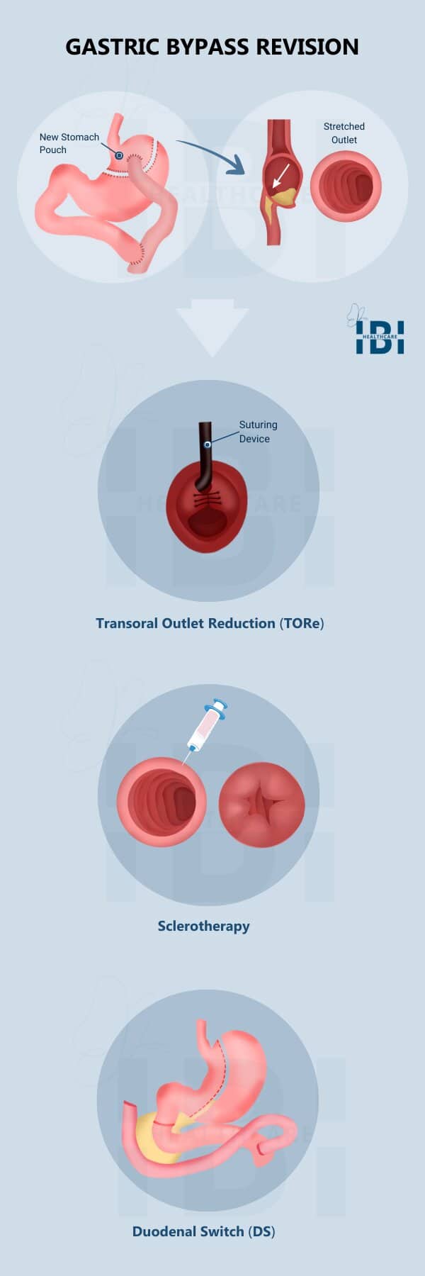 Illustration: Gastric Bypass Revision