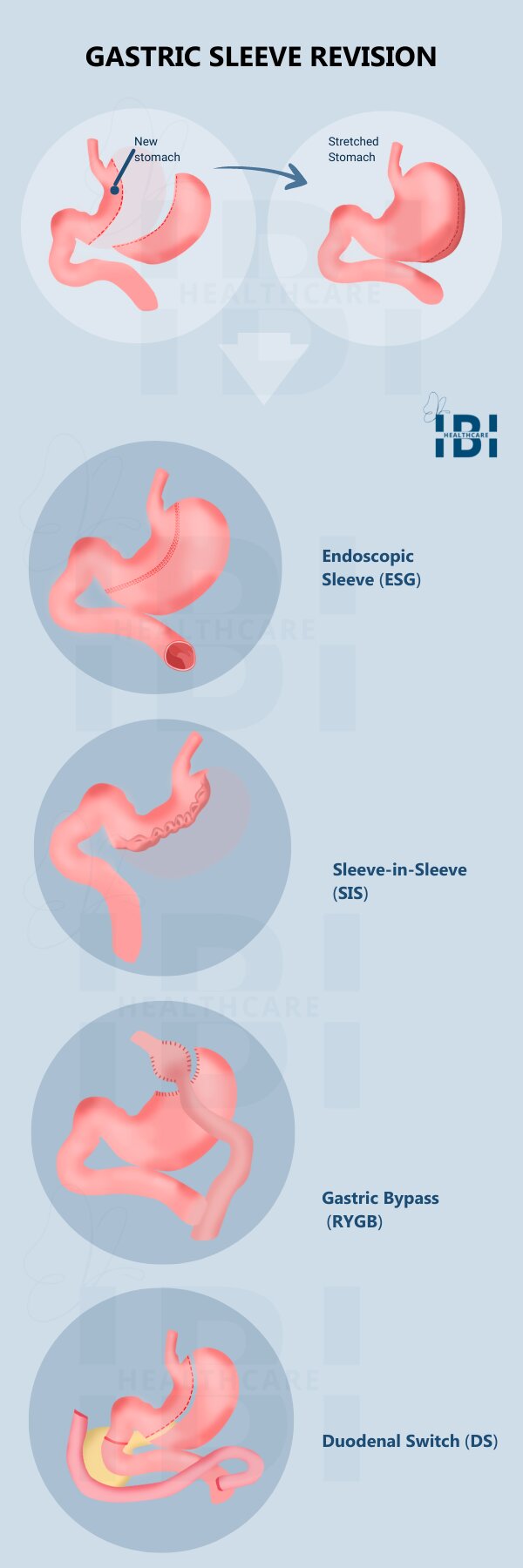 Illustration: Gastric Sleeve Revision