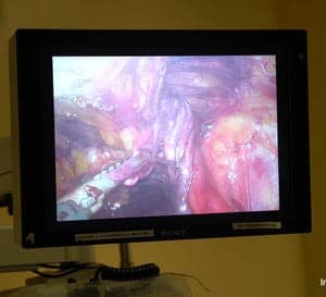 View of the inguinal hernia through the laparoscope