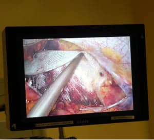 The surgeon is repairing the inguinal hernia with the mesh