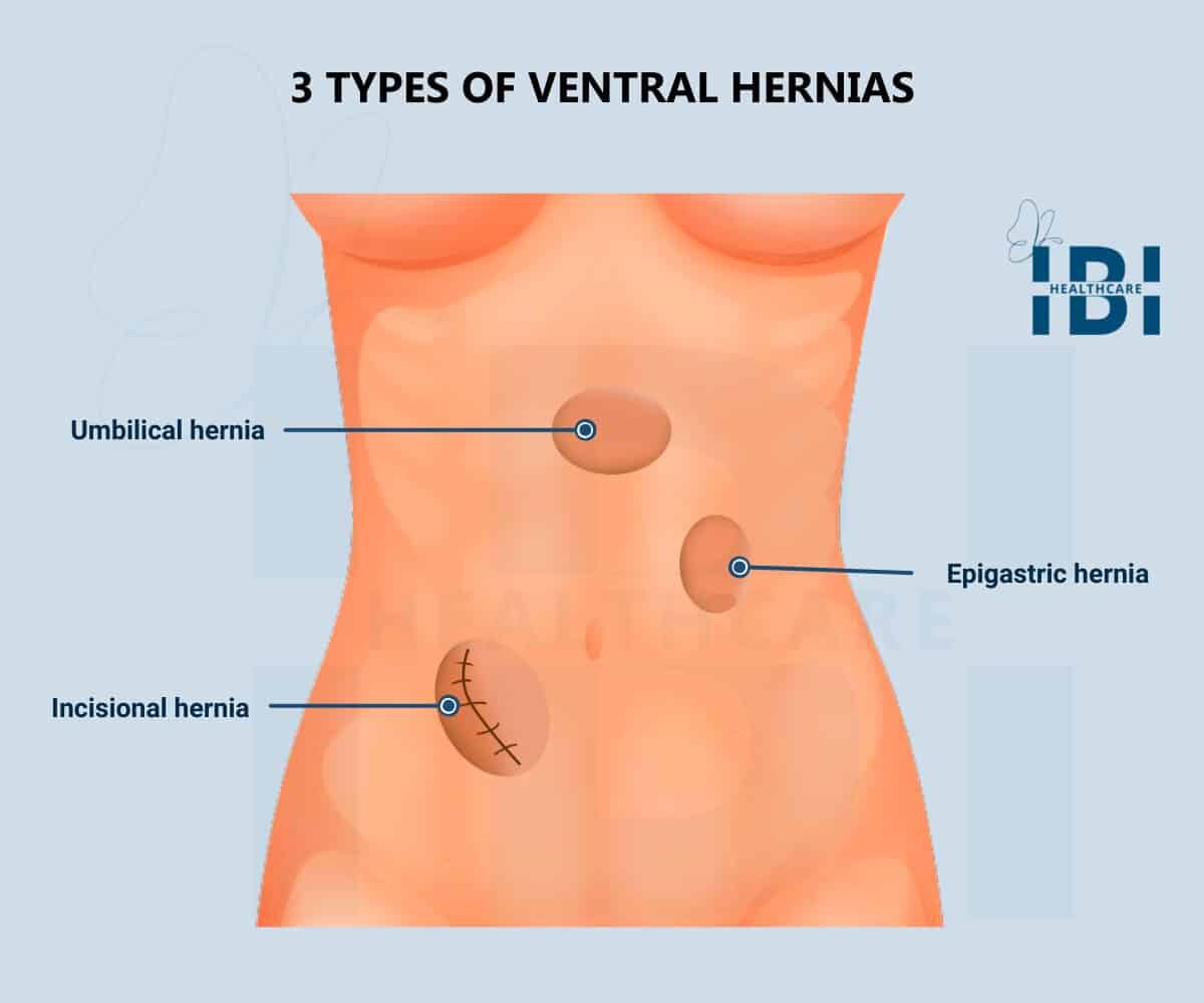 Illustration: 3 types of ventral hernias