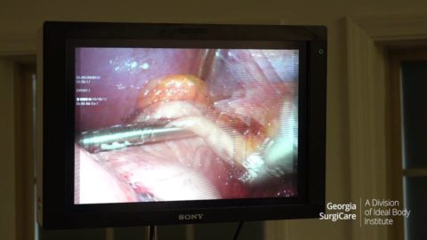 View From the Laparoscope: Rerouting the Small Intestine