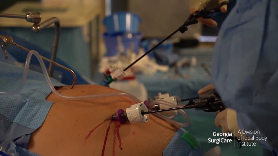 Real Surgery: Laparoscopic Mini Gastric Bypass