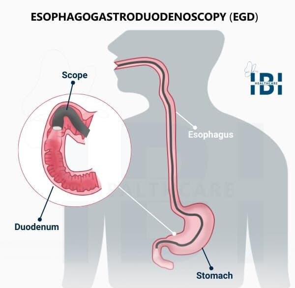Esophagogastroduodenoscopy (EGD)