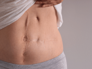 Gastric Sleeve Scars and Incisions