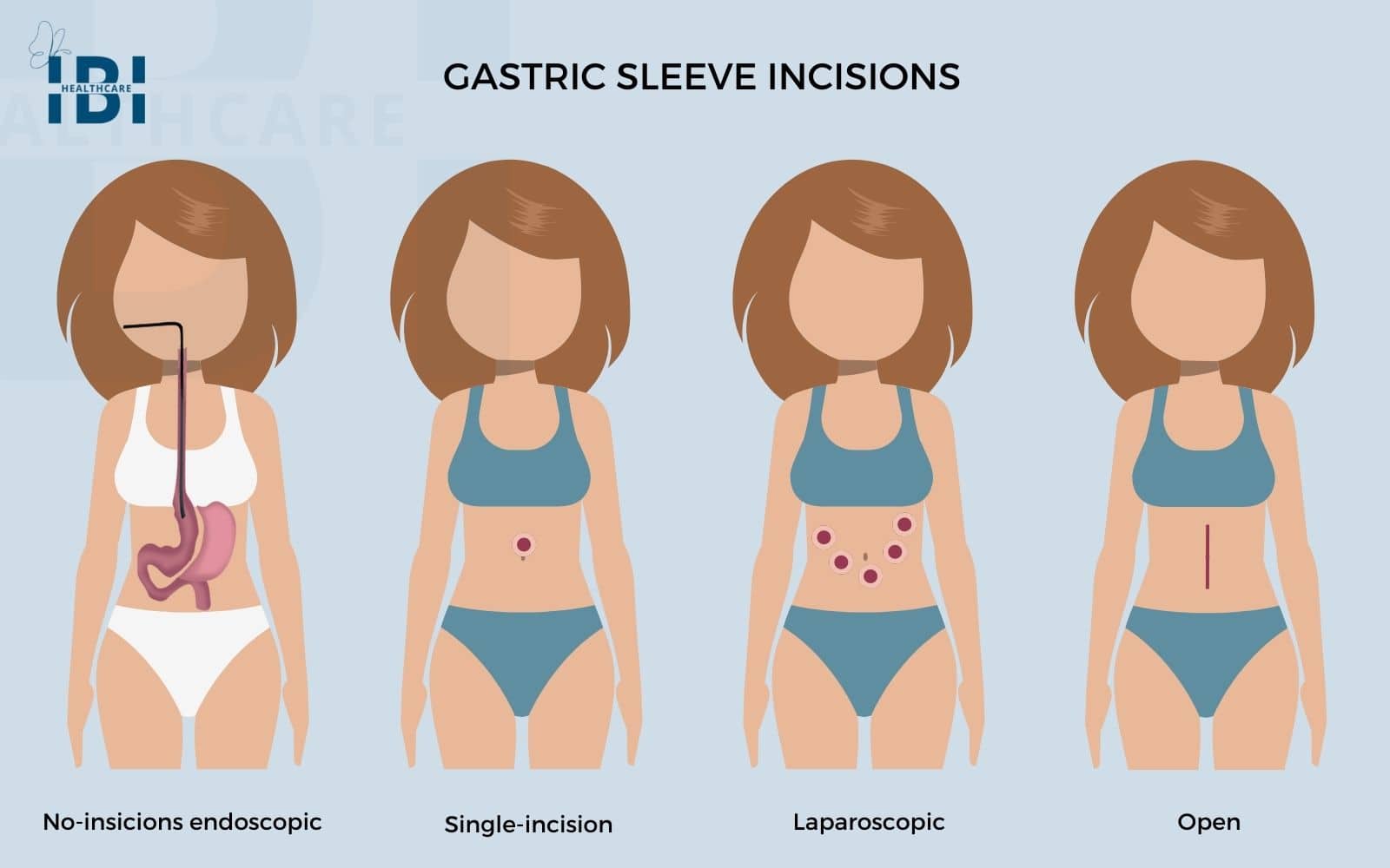 Gastric sleeve incisions and scars