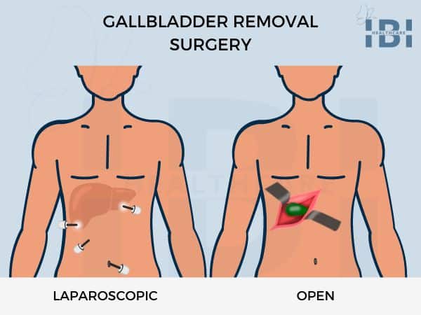 Gallbladder removal surgery types: laparoscopic and open