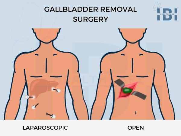 Laparoscopic Gallbladder Removal Surgery Single Incision