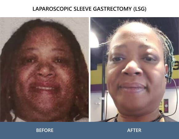 Before and after gastric sleeve surgery