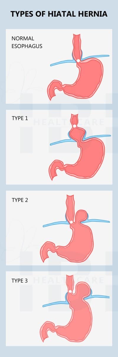 Types of hiatal hernias