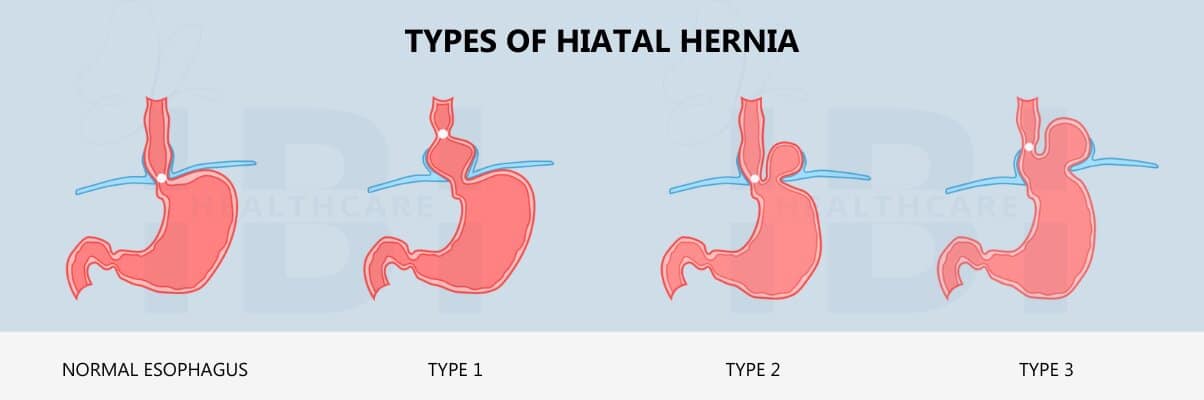 Types of hiatal hernias