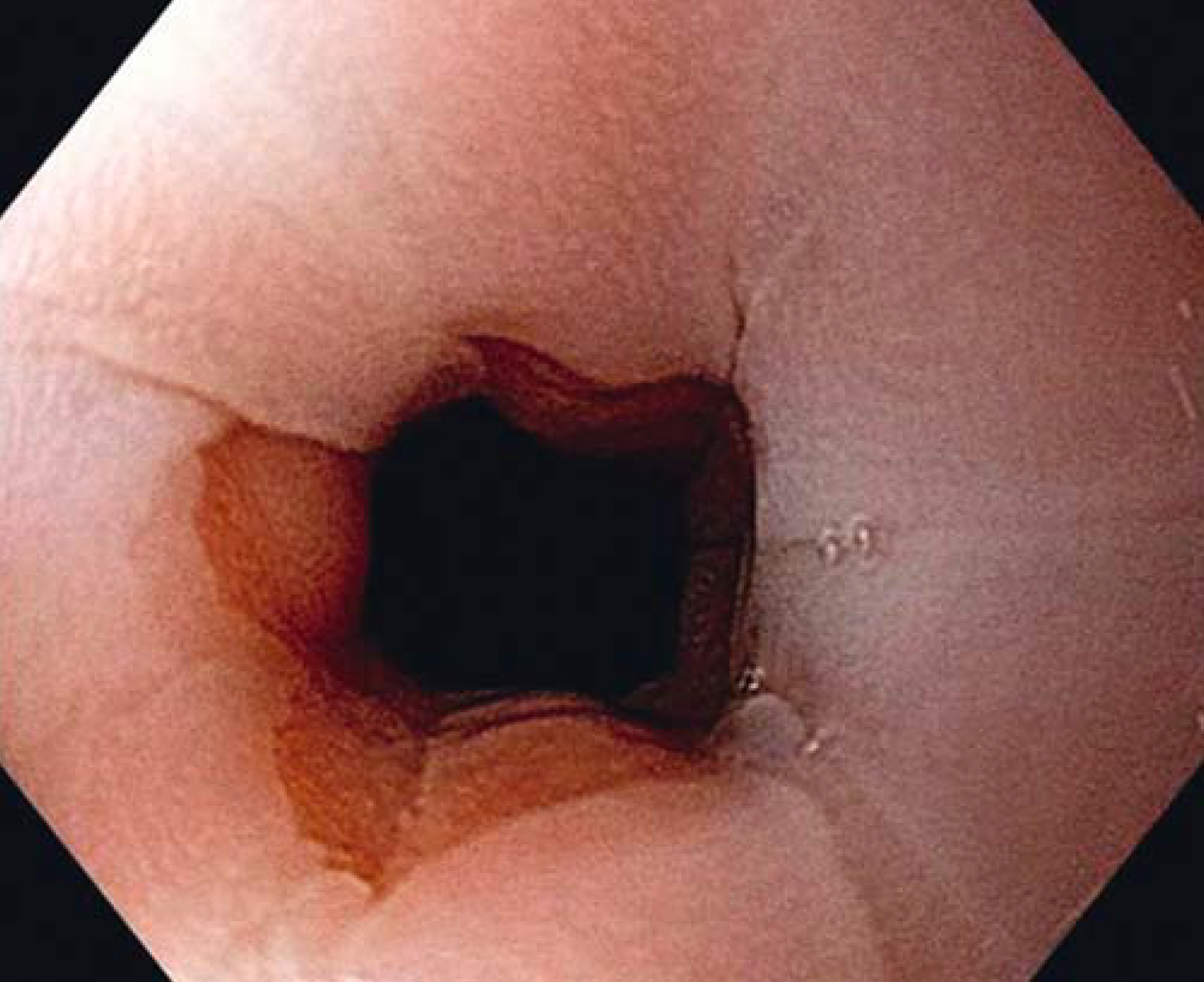 Endoscopic Sphincter Augmentation (ESA)