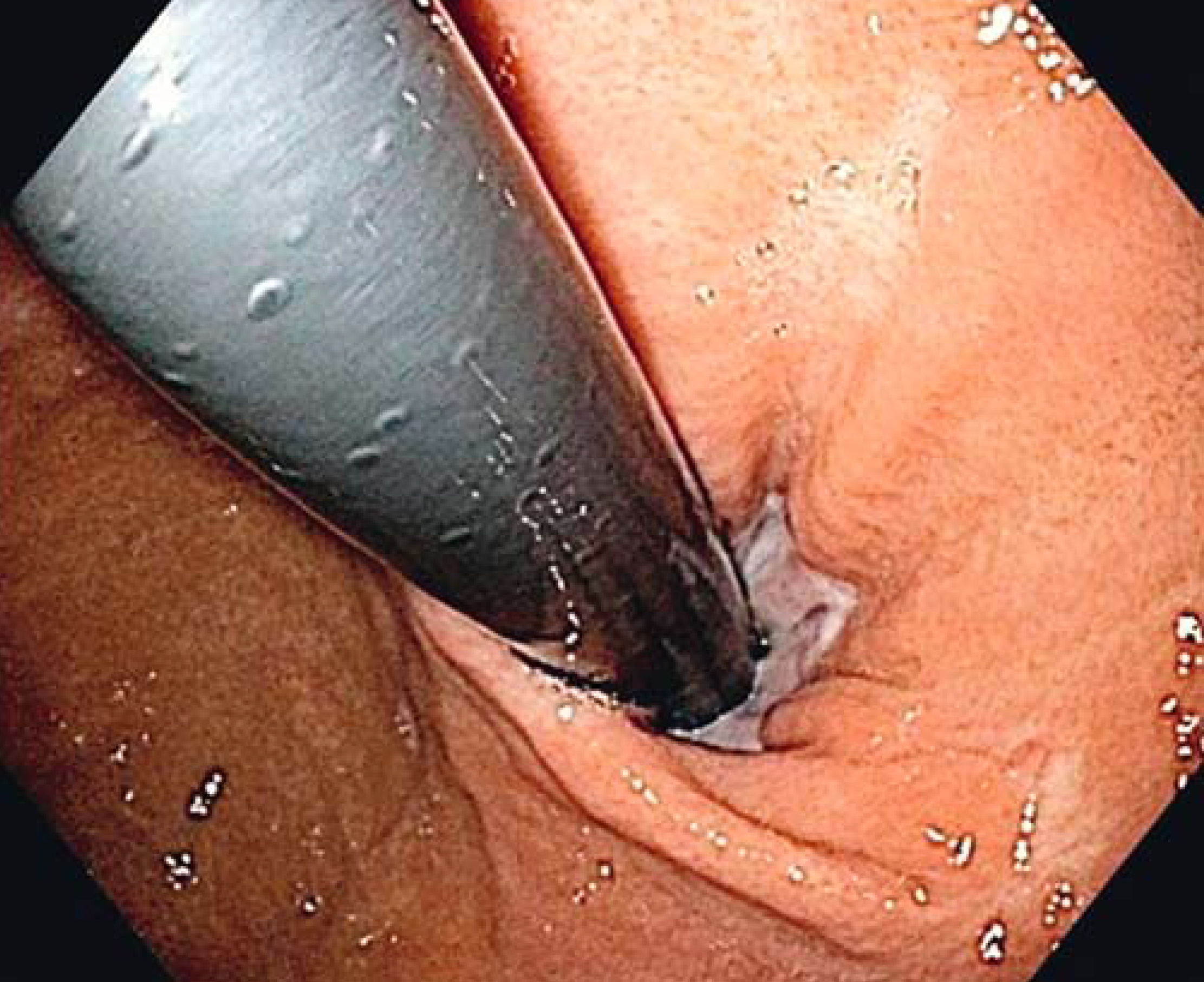 Endoscopic Sphincter Augmentation (ESA)