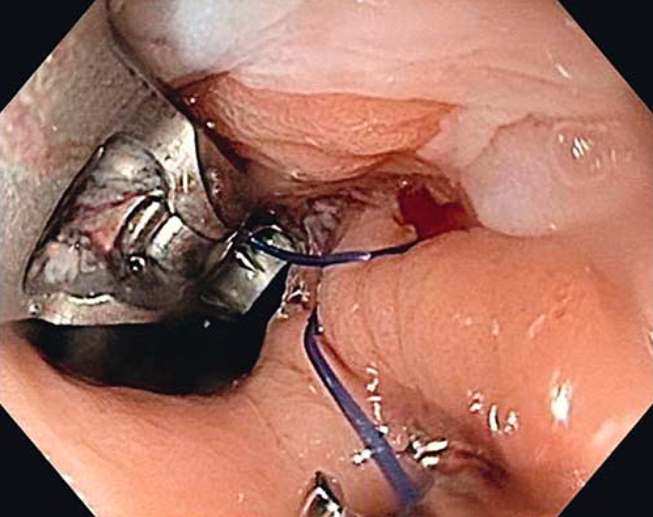 Endoscopic Sphincter Augmentation (ESA)