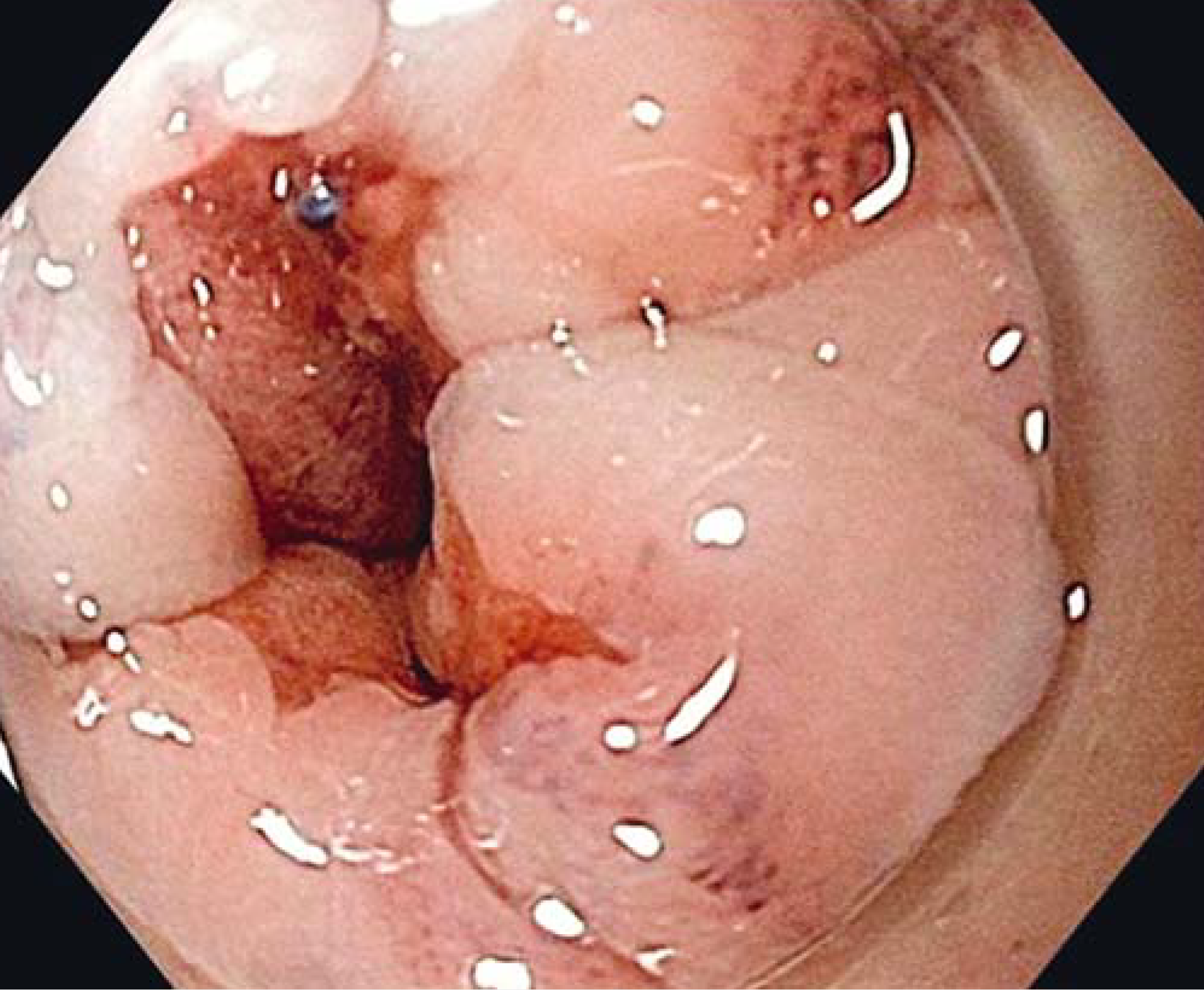 Endoscopic Sphincter Augmentation (ESA)