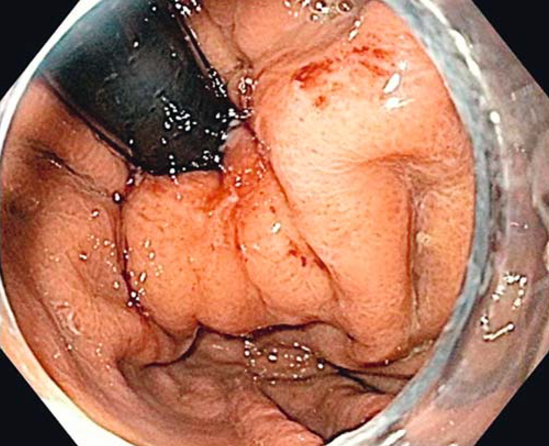 Endoscopic Sphincter Augmentation (ESA)